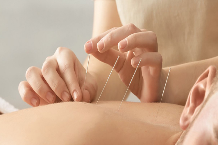 Điện mãng châm điều trị đau dây thần kinh liên sườn